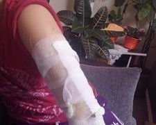 Edremitte hıdrellez ateşine düşen gencin kolu yandı. 