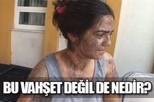 “”ELLERİN KIRILSIN”” Eşinin yüzünü asitle yaktı!
