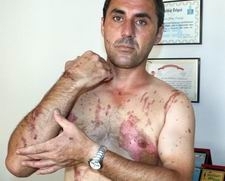 – KARISININ YÜZÜNÜ ASİTLE YAKTIĞI İDDİA EDİLEN KOCA KONUŞTU: –