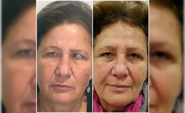 İzmir’de yaşayan kadın, göz kaslarından felç geçirmesi sonucu meydana gelen