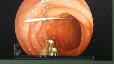 Bursa’da 9 aylık bebeğin yuttuğu 4 santim boyundaki iğne Yüksek