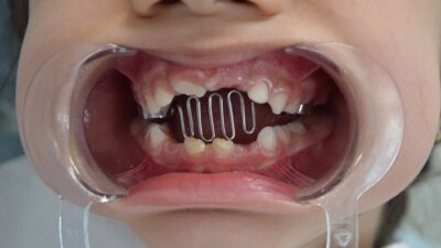  Diş Hekimi İlke Kardelen, Çocuklarda Sık Görülebilen Parmak Emme