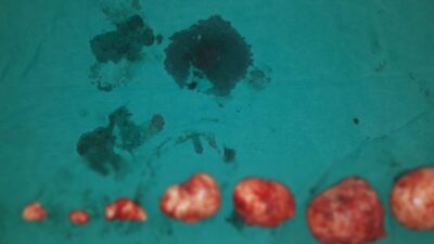 Çanakkale’nin Biga ilçesinde 32 yaşındaki bir kadının rahminden 1 kiloluk